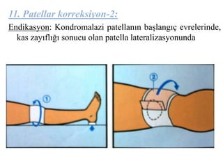 11. Patellar korreksiyon-2: 
Endikasyon: Kondromalazi patellanın başlangıç evrelerinde, 
kas zayıflığı sonucu olan patella lateralizasyonunda 
 