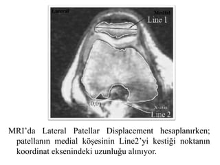 Lateral Medial 
MRI’da Lateral Patellar Displacement hesaplanırken; 
patellanın medial köşesinin Line2’yi kestiği noktanın 
koordinat eksenindeki uzunluğu alınıyor. 
 
