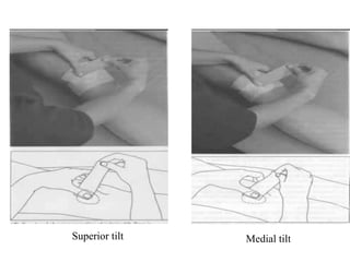 Superior tilt Medial tilt 
 