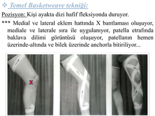  Temel Basketweave tekniği: 
Pozisyon: Kişi ayakta dizi hafif fleksiyonda duruyor. 
*** Medial ve lateral eklem hattında X bantlaması oluşuyor, 
mediale ve laterale sıra ile uygulanıyor, patella etrafında 
baklava dilimi görüntüsü oluşuyor, patellanın hemen 
üzerinde-altında ve bilek üzerinde anchorla bitiriliyor... 
 