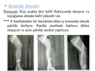  Butterfly Tekniği: 
Pozisyon: Kişi ayakta dizi hafif fleksiyonda duruyor ve 
topuğunun altında hafif yükselti var. 
*** X bantlamaları bir öncekinin daha iç kısmında olucak 
şekilde ilerliyor. Patella etrafında baklava dilimi 
oluşuyor ve aynı şekilde anchor yapılıyor. 
 