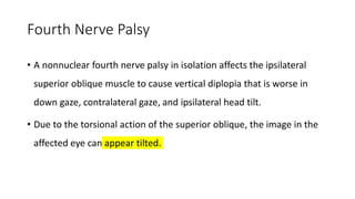 Fourth Nerve Palsy
• A nonnuclear fourth nerve palsy in isolation affects the ipsilateral
superior oblique muscle to cause vertical diplopia that is worse in
down gaze, contralateral gaze, and ipsilateral head tilt.
• Due to the torsional action of the superior oblique, the image in the
affected eye can appear tilted.
 