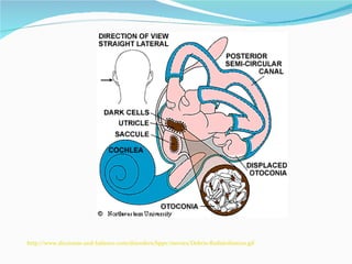 http://www.dizziness-and-balance.com/disorders/bppv/movies/Debris-Redistribution.gif 
