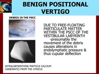 BENIGN POSITIONAL
VERTIGO
DEBRIS IN THE PSCC
INTRALABYRINTHINE PARTICLE CALCIUM
CARBONATE) FROM THE UTRICLE
DUE TO FREE-FLOATING
PARTICULATE MATTER
WITHIN THE PSCC OF THE
VESTIBULAR LABYRINTH
-presumably the
movement of the debris
causes alterations in
endolymphatic pressure &
thus cupular deflection
 