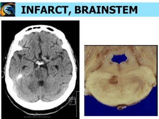 INFARCT, BRAINSTEM
 