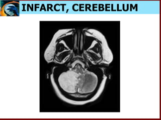 INFARCT, CEREBELLUM
 