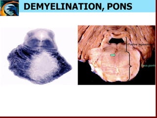 DEMYELINATION, PONS
 