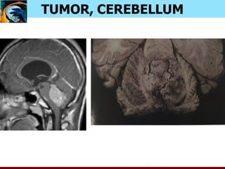 TUMOR, CEREBELLUM
 