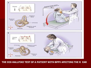 THE DIX-HALLPIKE TEST OF A PATIENT WITH BPPV AFECTING THE R EAR
 