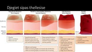 Djegiet sipas thellesise
 