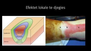 Efektet lokale te djegies
 