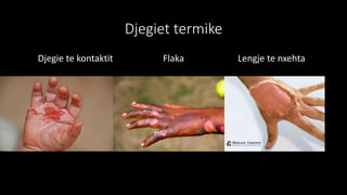 Djegiet termike
Djegie te kontaktit Flaka Lengje te nxehta
 