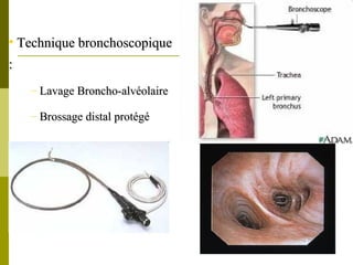 • TTeecchhnniiqquuee bbrroonncchhoossccooppiiqquuee 
:: 
– LLaavvaaggee BBrroonncchhoo--aallvvééoollaaiirree 
– BBrroossssaaggee ddiissttaall pprroottééggéé 
 
