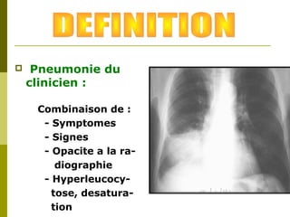  Pneumonie du 
clinicien : 
Combinaison de : 
- Symptomes 
- Signes 
- Opacite a la ra-diographie 
- Hyperleucocy-tose, 
desatura-tion 
 