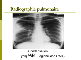 RRaaddiiooggrraapphhiiee ppuullmmoonnaaiirree 
Condensation 
TypiquLeS dDet …légionellose (75%) 
 