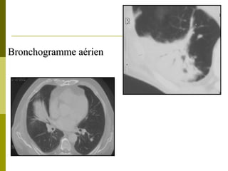 Bronchogramme aérien 
 