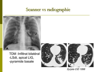 SSccaannnneerr vvss rraaddiiooggrraapphhiiee 
TDM :Infiltrat bilatéral 
-LSdt, apical LIG, 
-pyramide basale 
Syrjala CID 1998 
 