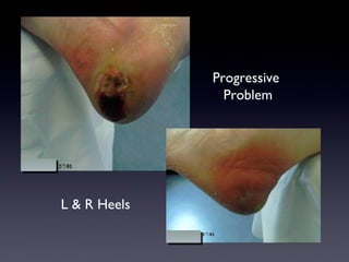 Progressive
                Problem




L & R Heels
 