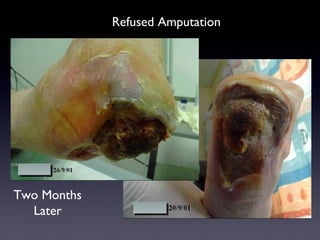 Refused Amputation




Two Months
  Later
 
