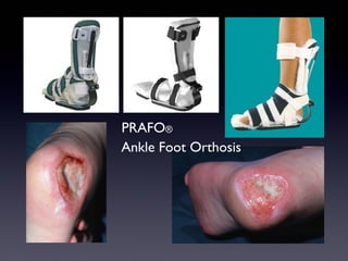 PRAFO®
Ankle Foot Orthosis
 