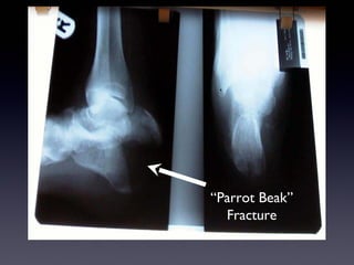 “Parrot Beak”
  Fracture
 