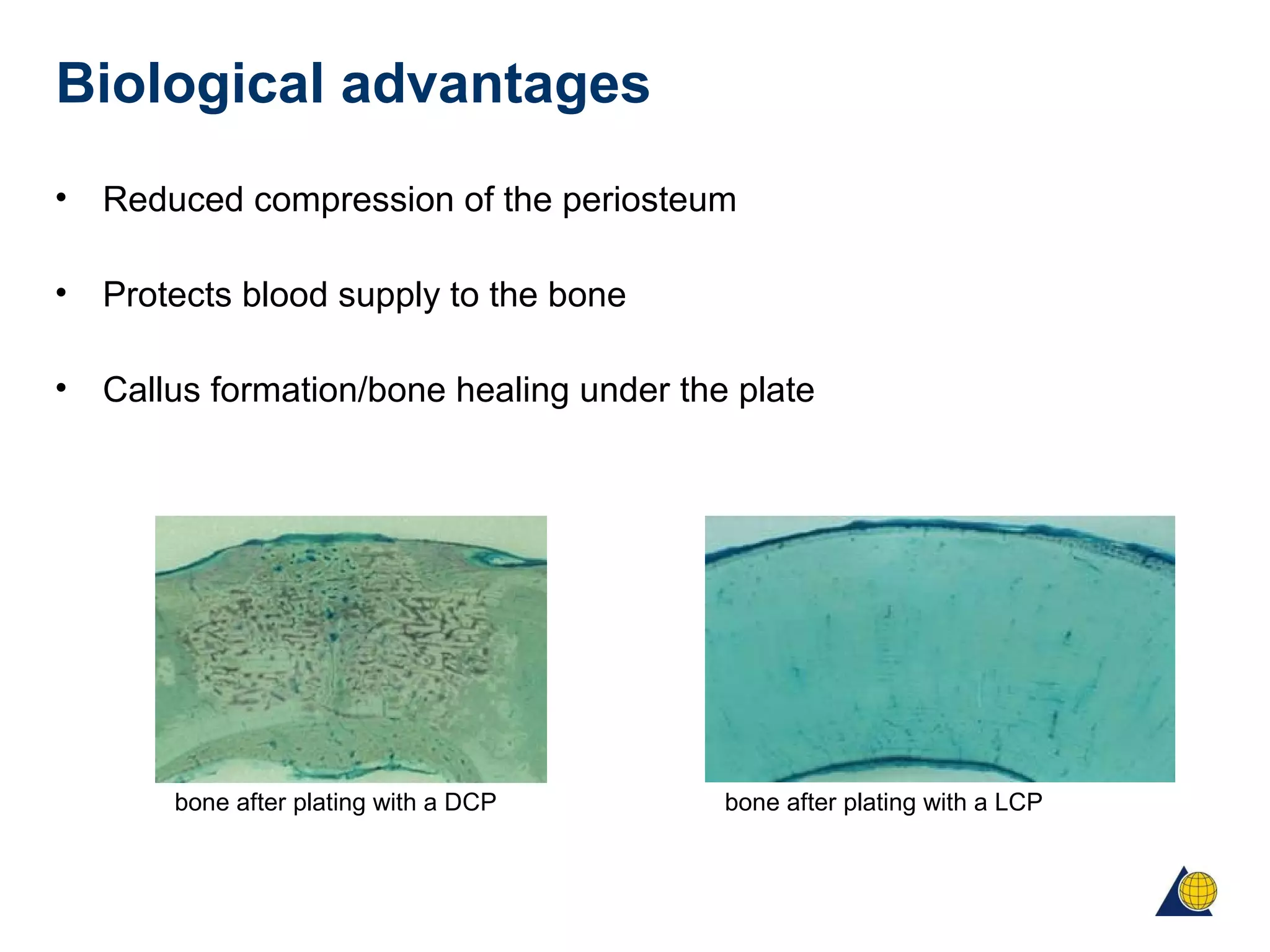 Biological advantages
• Reduced compression of the periosteum
• Protects blood supply to the bone
• Callus formation/bone healing under the plate
bone after plating with a DCP bone after plating with a LCP
 