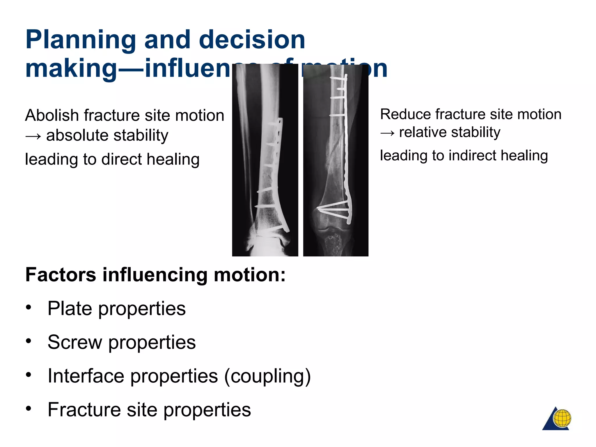 Planning and decision
making―influence of motion
Abolish fracture site motion
→ absolute stability
leading to direct healing
Factors influencing motion:
• Plate properties
• Screw properties
• Interface properties (coupling)
• Fracture site properties
Reduce fracture site motion
→ relative stability
leading to indirect healing
 