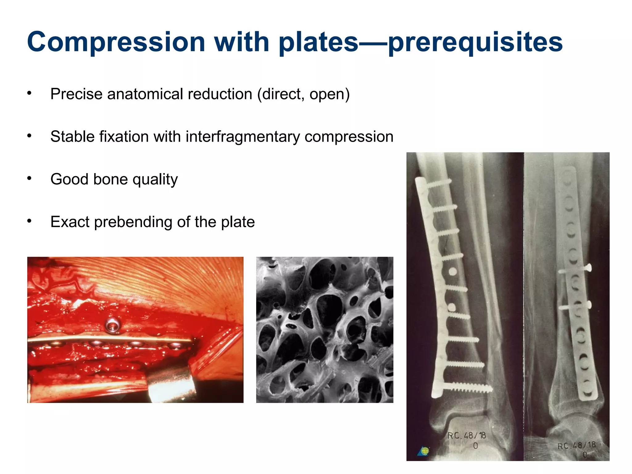 Compression with plates—prerequisites
• Precise anatomical reduction (direct, open)
• Stable fixation with interfragmentary compression
• Good bone quality
• Exact prebending of the plate
 