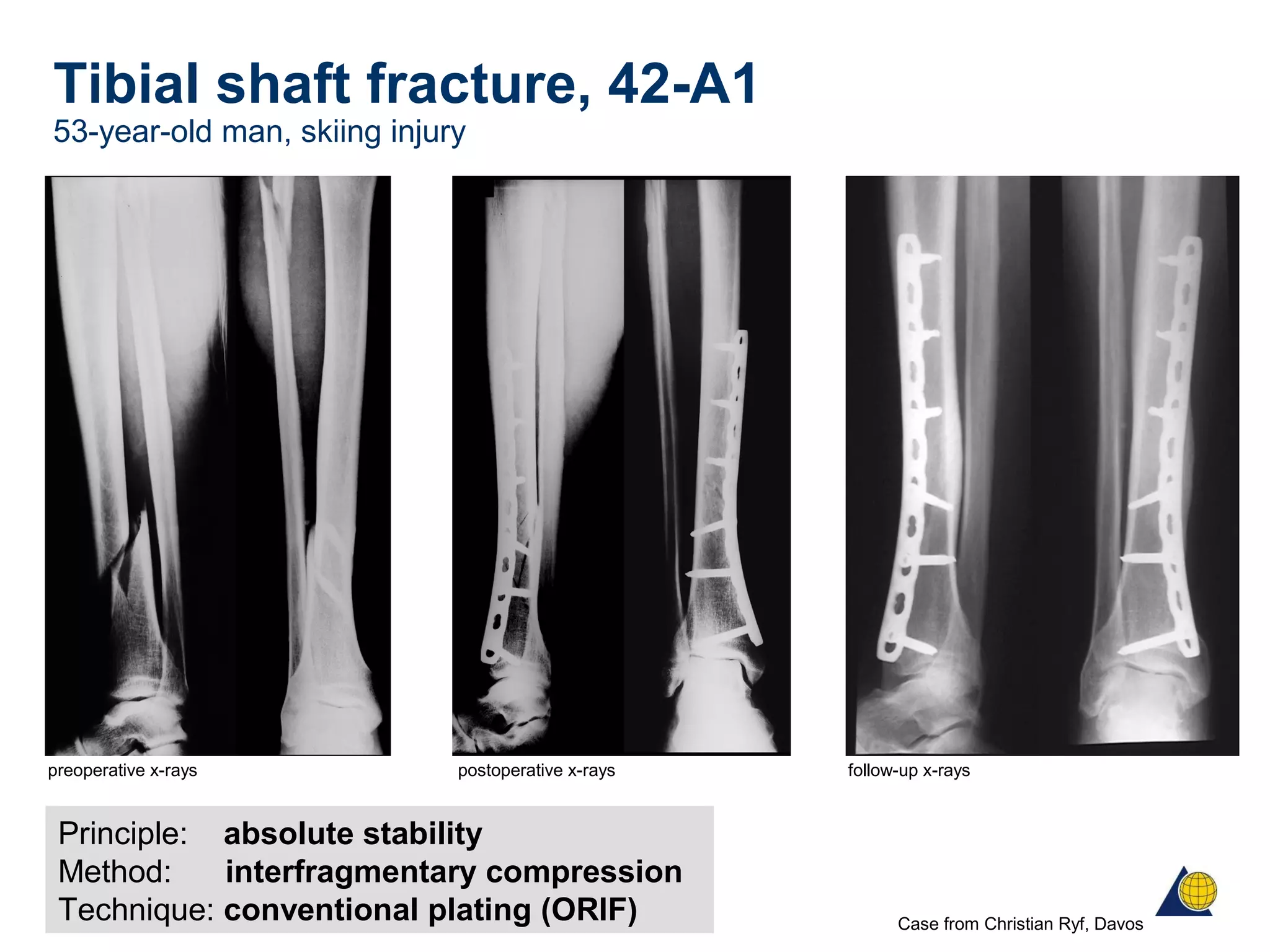 Tibial shaft fracture, 42-A1
53-year-old man, skiing injury
Principle: absolute stability
Method: interfragmentary compression
Technique: conventional plating (ORIF)
first step
preoperative x-rays postoperative x-rays follow-up x-rays
Case from Christian Ryf, Davos
 