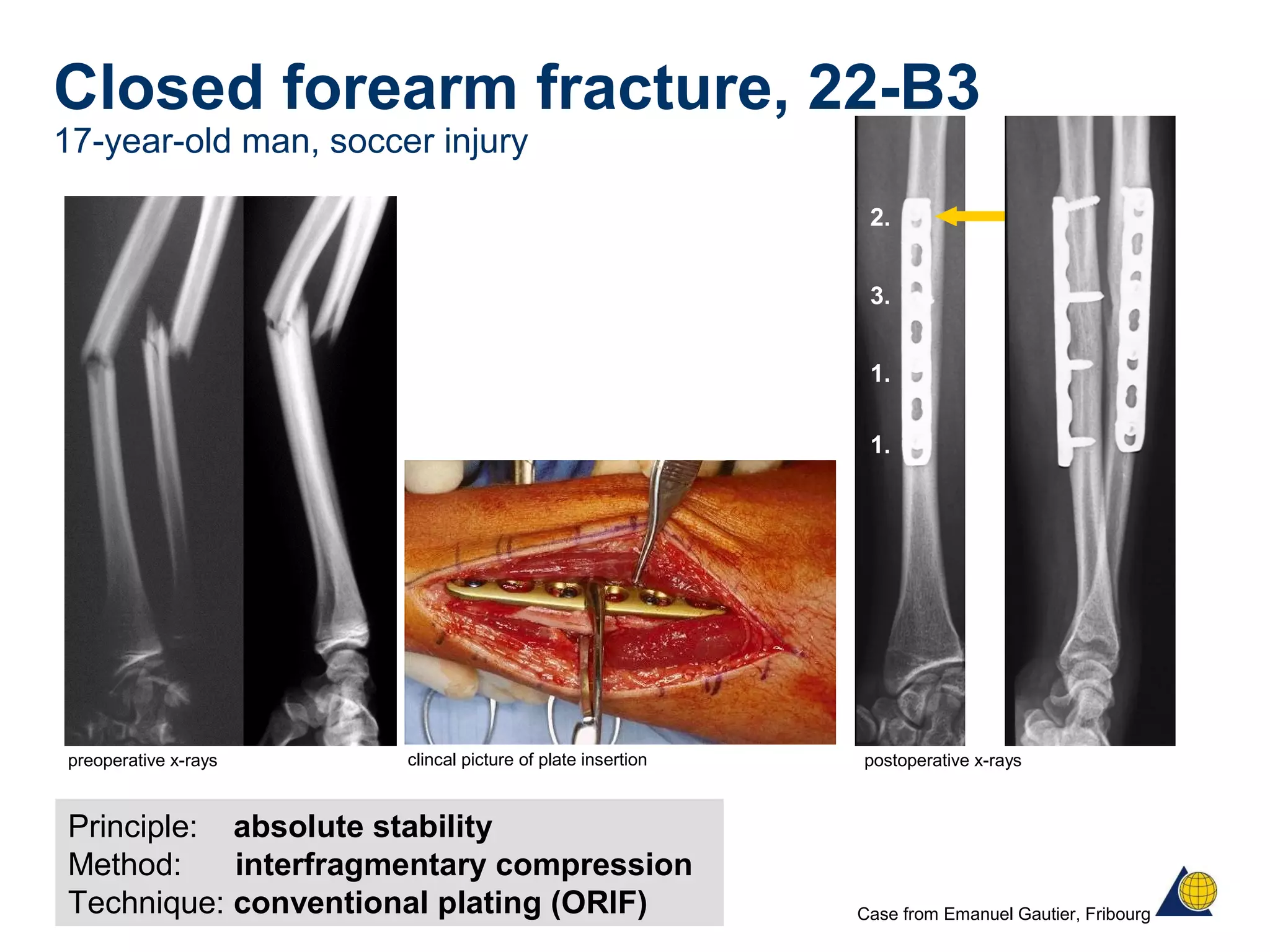 Closed forearm fracture, 22-B3
17-year-old man, soccer injury
1.
1.
3.
2.
Principle: absolute stability
Method: interfragmentary compression
Technique: conventional plating (ORIF)
preoperative x-rays postoperative x-rays
Case from Emanuel Gautier, Fribourg
clincal picture of plate insertion
 