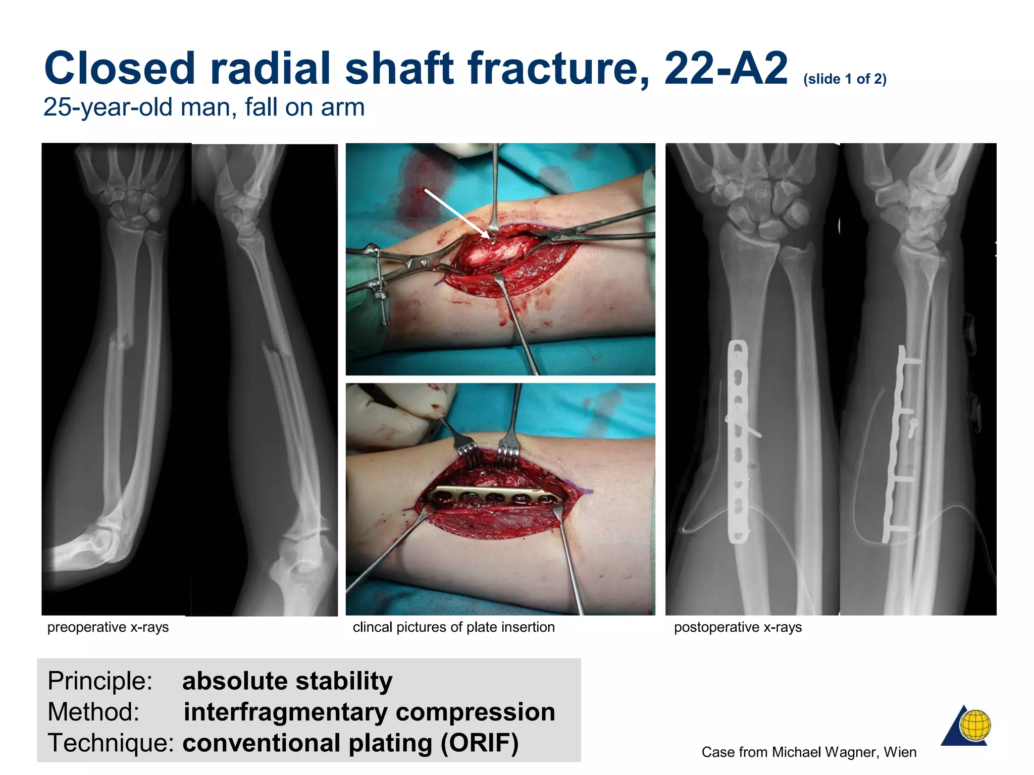 Closed radial shaft fracture, 22-A2 (slide 1 of 2)
25-year-old man, fall on arm
Principle: absolute stability
Method: interfragmentary compression
Technique: conventional plating (ORIF)
preoperative x-rays postoperative x-rays
Case from Michael Wagner, Wien
clincal pictures of plate insertion
 