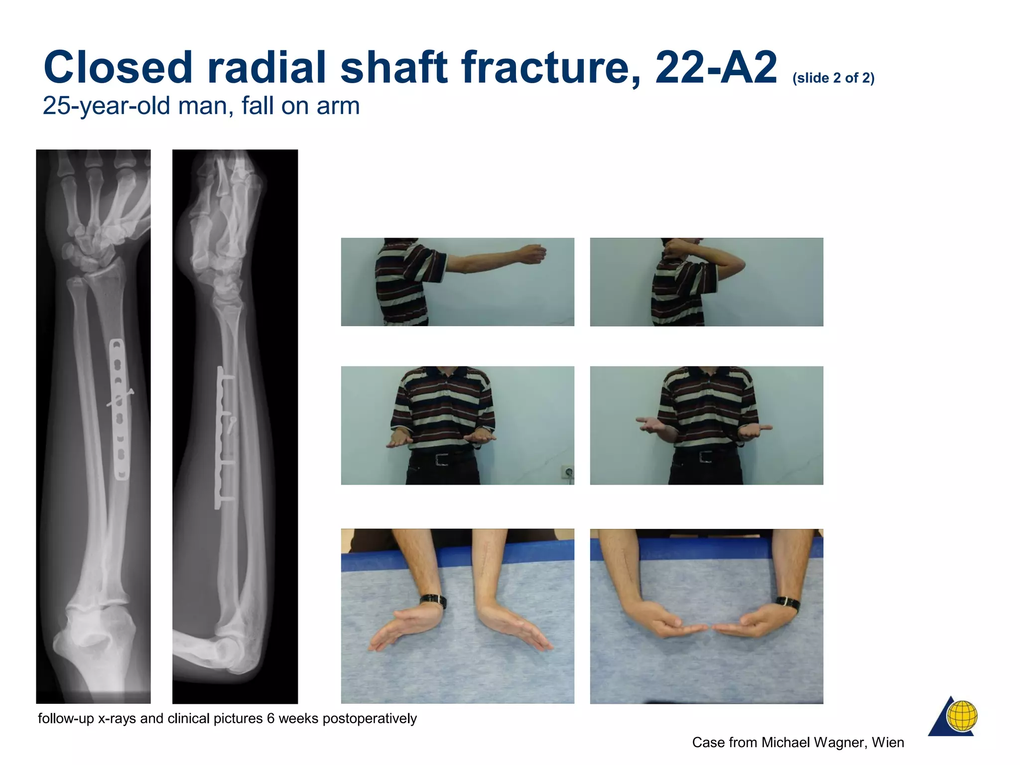 Closed radial shaft fracture, 22-A2 (slide 2 of 2)
25-year-old man, fall on arm
Case from Michael Wagner, Wien
follow-up x-rays and clinical pictures 6 weeks postoperatively
 
