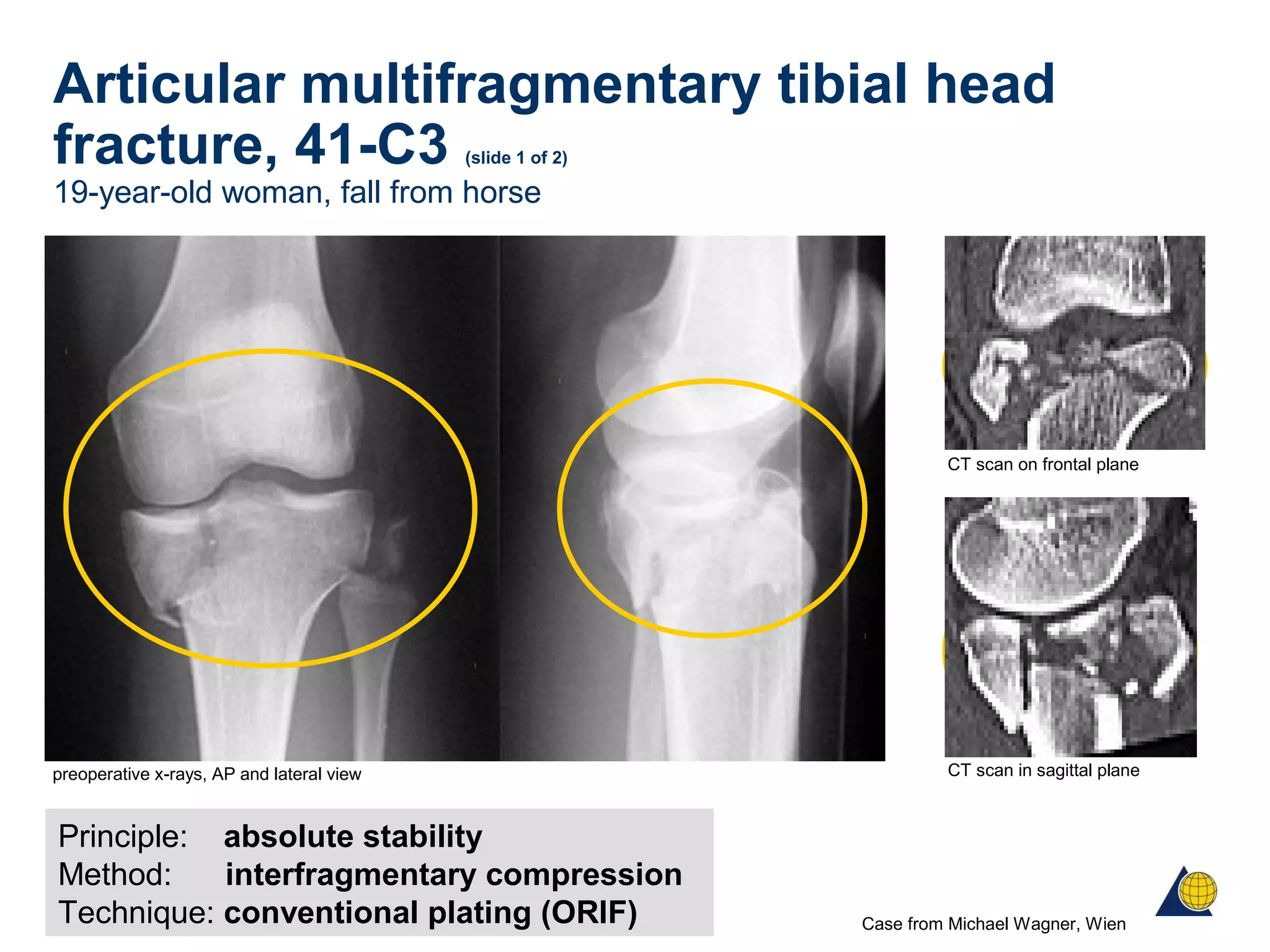 Articular multifragmentary tibial head
fracture, 41-C3 (slide 1 of 2)
19-year-old woman, fall from horse
Principle: absolute stability
Method: interfragmentary compression
Technique: conventional plating (ORIF) Case from Michael Wagner, Wien
preoperative x-rays, AP and lateral view CT scan in sagittal plane
CT scan on frontal plane
 
