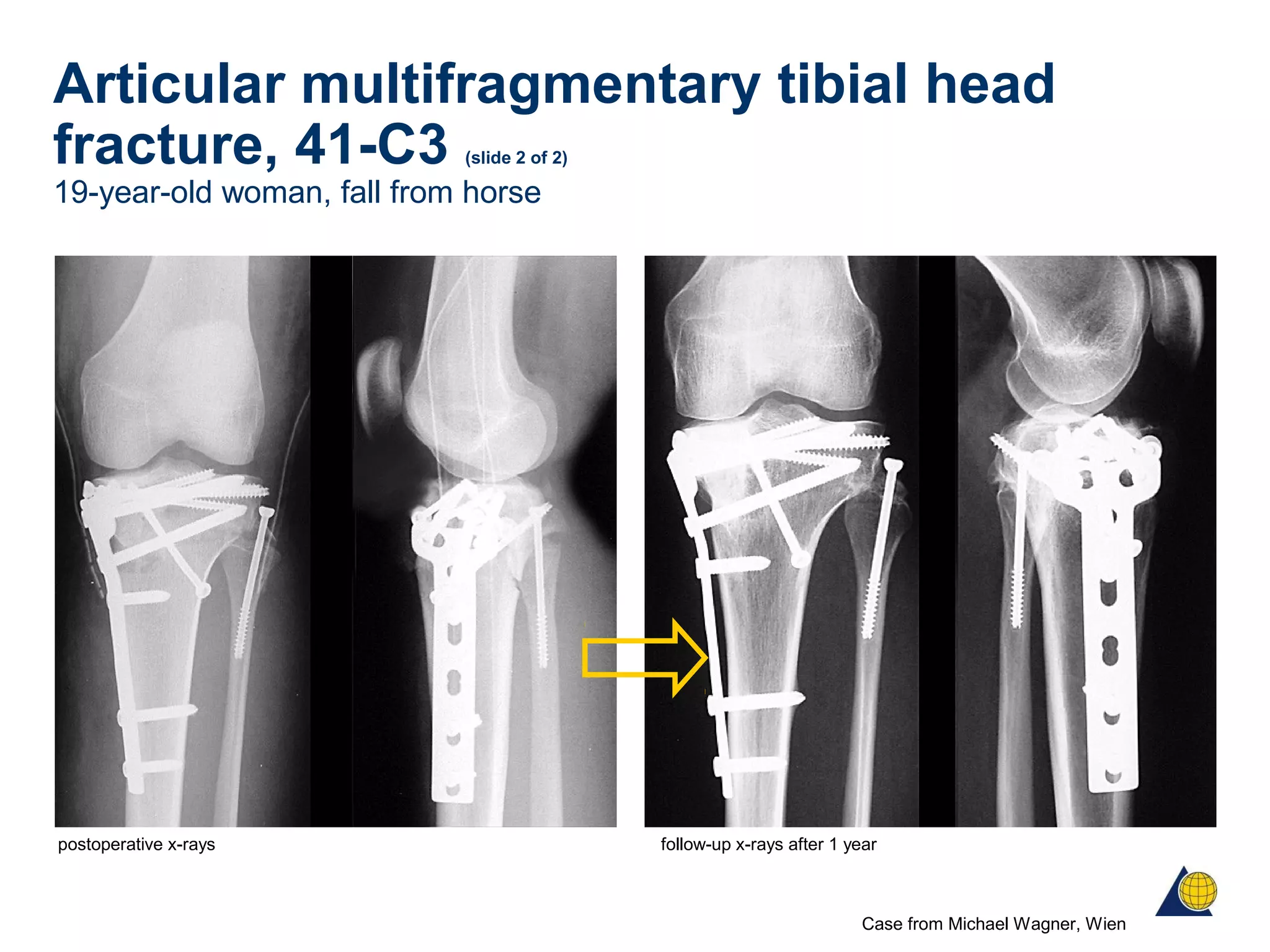 Articular multifragmentary tibial head
fracture, 41-C3 (slide 2 of 2)
19-year-old woman, fall from horse
Case from Michael Wagner, Wien
postoperative x-rays follow-up x-rays after 1 year
 
