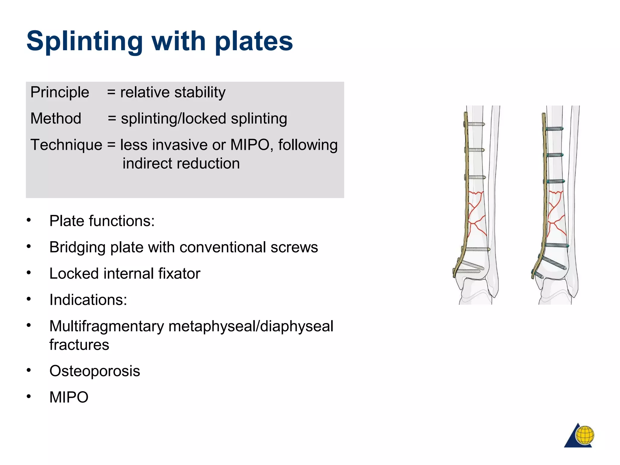 Splinting with plates
Principle = relative stability
Method = splinting/locked splinting
Technique = less invasive or MIPO, following
indirect reduction
• Plate functions:
• Bridging plate with conventional screws
• Locked internal fixator
• Indications:
• Multifragmentary metaphyseal/diaphyseal
fractures
• Osteoporosis
• MIPO
 