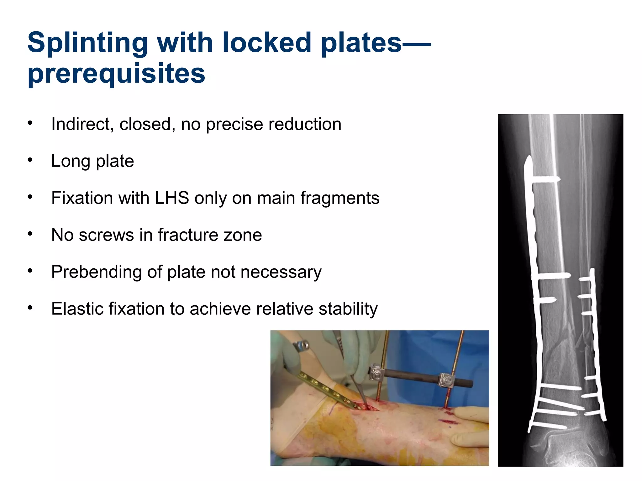 Splinting with locked plates—
prerequisites
• Indirect, closed, no precise reduction
• Long plate
• Fixation with LHS only on main fragments
• No screws in fracture zone
• Prebending of plate not necessary
• Elastic fixation to achieve relative stability
 