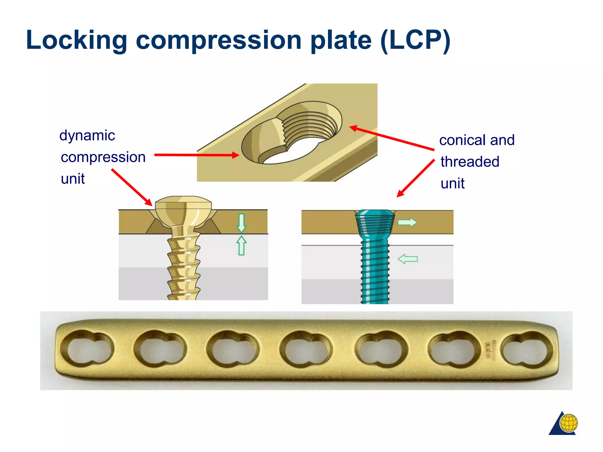 Locking compression plate (LCP)
dynamic
compression
unit
conical and
threaded
unit
 