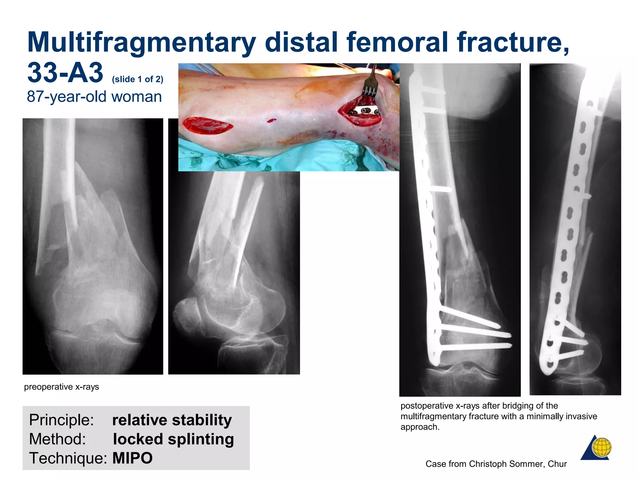 Multifragmentary distal femoral fracture,
33-A3 (slide 1 of 2)
87-year-old woman
Principle: relative stability
Method: locked splinting
Technique: MIPO
preoperative x-rays
postoperative x-rays after bridging of the
multifragmentary fracture with a minimally invasive
approach.
follow-up x-rays
Case from Christoph Sommer, Chur
 