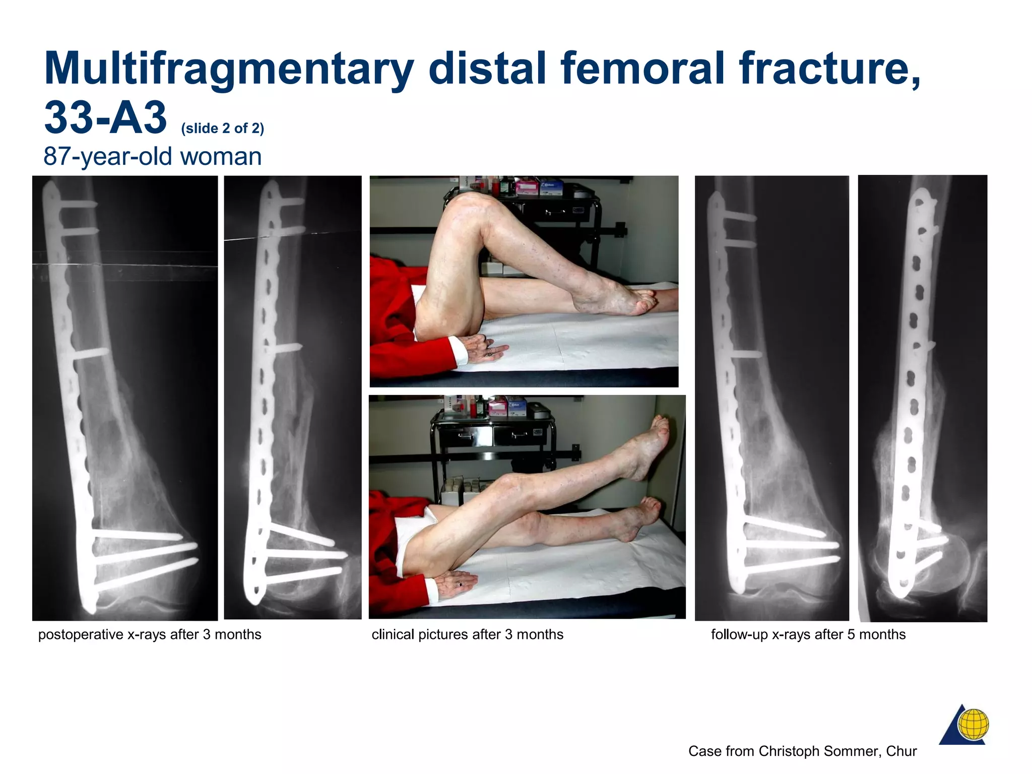 Multifragmentary distal femoral fracture,
33-A3 (slide 2 of 2)
87-year-old woman
postoperative x-rays after 3 months clinical pictures after 3 months follow-up x-rays after 5 months
Case from Christoph Sommer, Chur
 