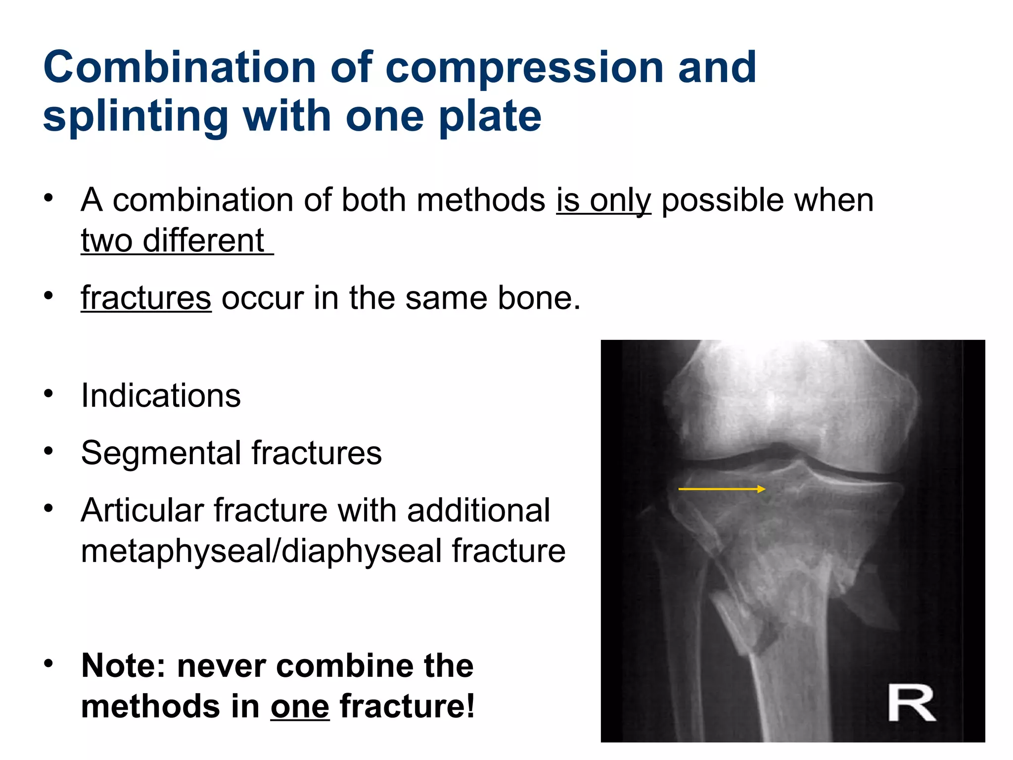 Combination of compression and
splinting with one plate
• A combination of both methods is only possible when
two different
• fractures occur in the same bone.
• Indications
• Segmental fractures
• Articular fracture with additional
metaphyseal/diaphyseal fracture
• Note: never combine the
methods in one fracture!
 