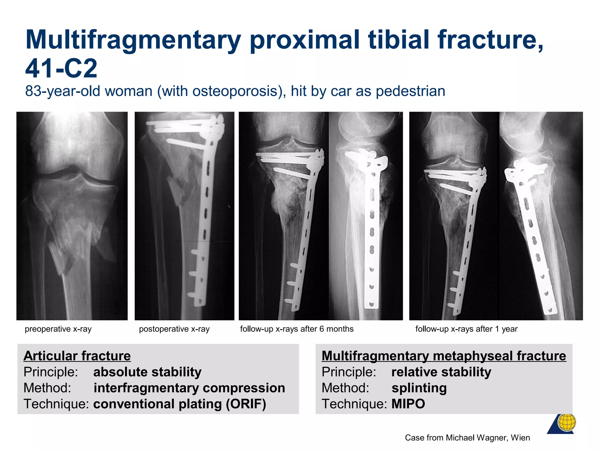 Multifragmentary proximal tibial fracture,
41-C2
83-year-old woman (with osteoporosis), hit by car as pedestrian
Articular fracture
Principle: absolute stability
Method: interfragmentary compression
Technique: conventional plating (ORIF)
preoperative x-ray follow-up x-rays after 6 months follow-up x-rays after 1 year
Case from Michael Wagner, Wien
postoperative x-ray
Multifragmentary metaphyseal fracture
Principle: relative stability
Method: splinting
Technique: MIPO
 