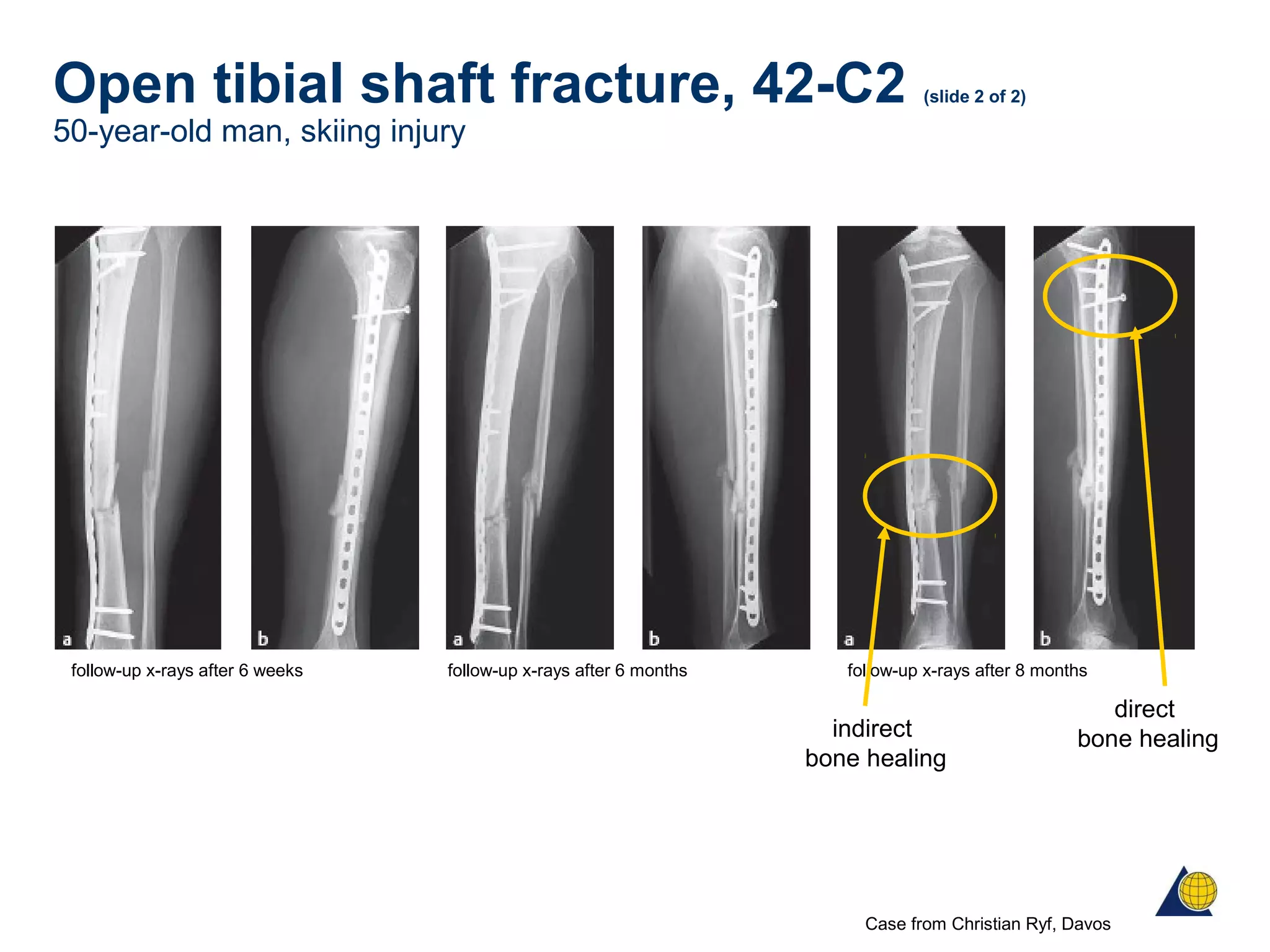 Open tibial shaft fracture, 42-C2 (slide 2 of 2)
50-year-old man, skiing injury
follow-up x-rays after 6 weeks follow-up x-rays after 6 months
Case from Christian Ryf, Davos
follow-up x-rays after 8 months
indirect
bone healing
direct
bone healing
 