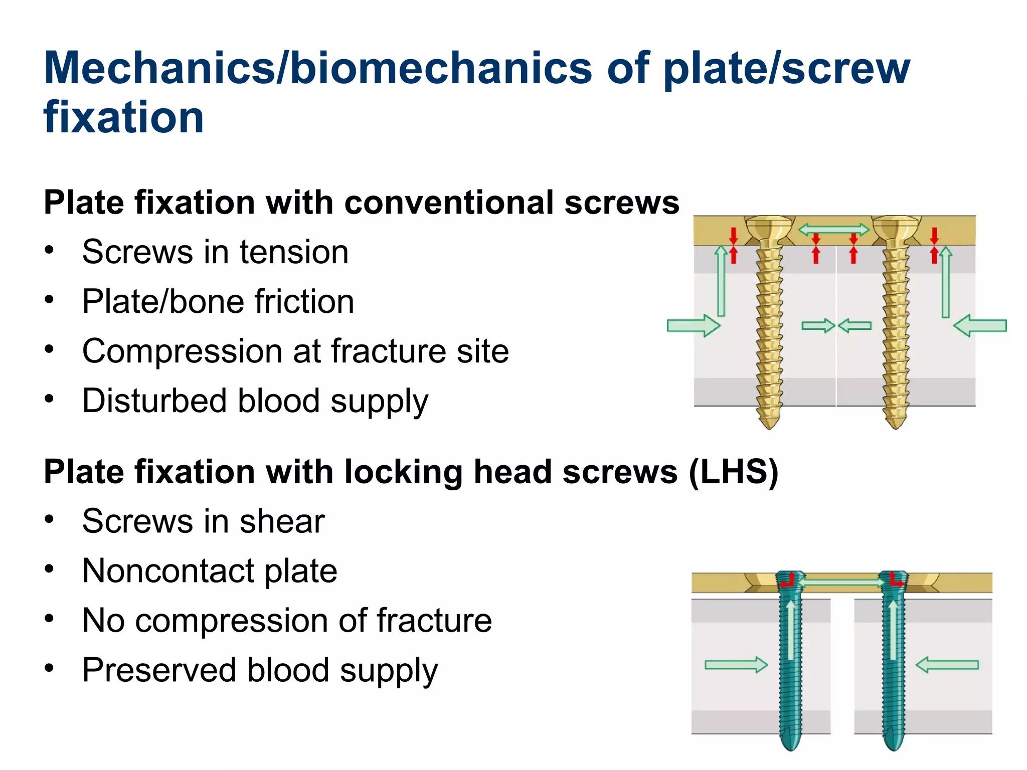 Mechanics/biomechanics of plate/screw
fixation
Plate fixation with conventional screws
• Screws in tension
• Plate/bone friction
• Compression at fracture site
• Disturbed blood supply
Plate fixation with locking head screws (LHS)
• Screws in shear
• Noncontact plate
• No compression of fracture
• Preserved blood supply
 