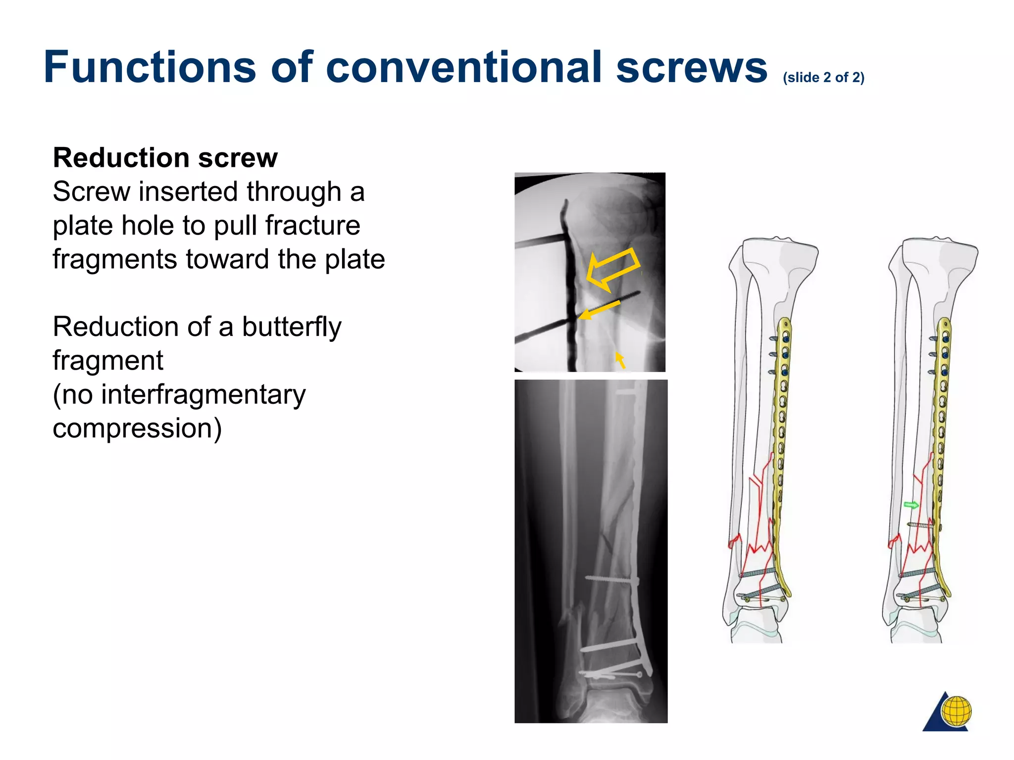 Functions of conventional screws (slide 2 of 2)
Reduction screw
Screw inserted through a
plate hole to pull fracture
fragments toward the plate
Reduction of a butterfly
fragment
(no interfragmentary
compression)
 