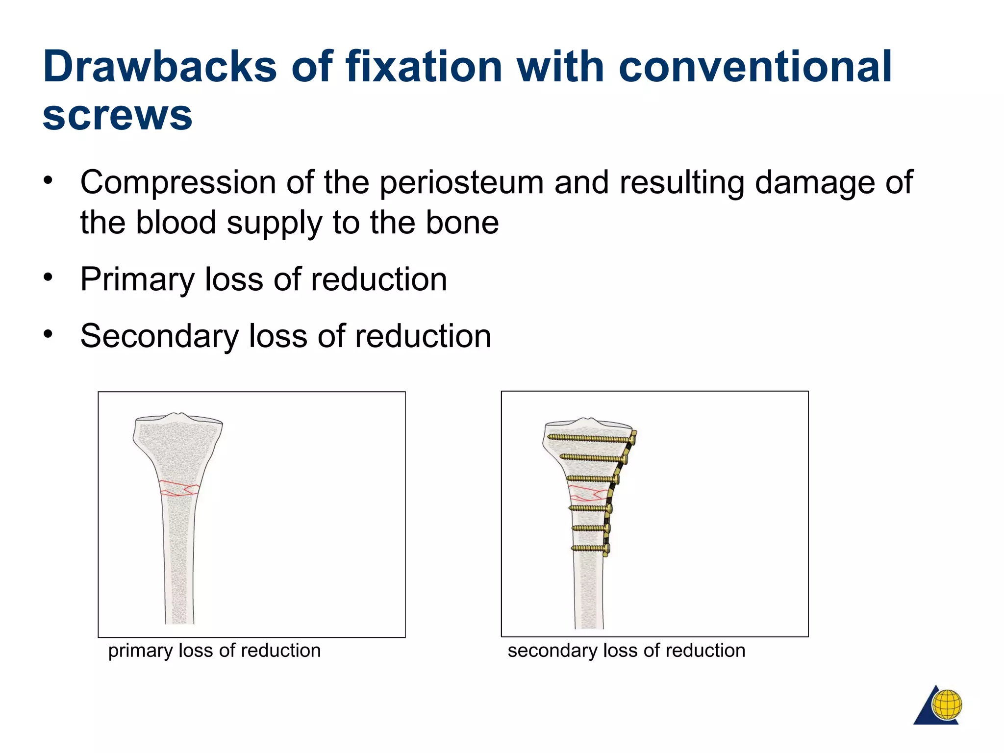 Drawbacks of fixation with conventional
screws
• Compression of the periosteum and resulting damage of
the blood supply to the bone
• Primary loss of reduction
• Secondary loss of reduction
primary loss of reduction secondary loss of reduction
 