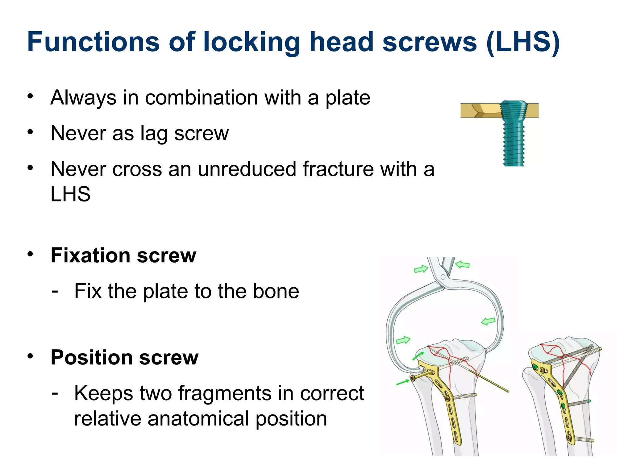 Functions of locking head screws (LHS)
• Always in combination with a plate
• Never as lag screw
• Never cross an unreduced fracture with a
LHS
• Fixation screw
- Fix the plate to the bone
• Position screw
- Keeps two fragments in correct
relative anatomical position
 