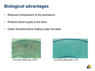 Biological advantages
• Reduced compression of the periosteum
• Protects blood supply to the bone
• Callus formation/bone healing under the plate
bone after plating with a DCP bone after plating with a LCP
 