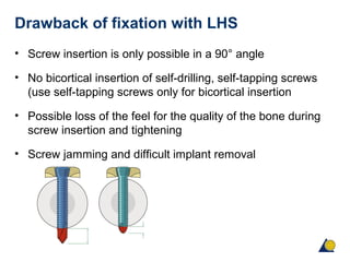 Drawback of fixation with LHS
• Screw insertion is only possible in a 90° angle
• No bicortical insertion of self-drilling, self-tapping screws
(use self-tapping screws only for bicortical insertion
• Possible loss of the feel for the quality of the bone during
screw insertion and tightening
• Screw jamming and difficult implant removal
 