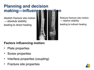 Planning and decision
making―influence of motion
Abolish fracture site motion
→ absolute stability
leading to direct healing
Factors influencing motion:
• Plate properties
• Screw properties
• Interface properties (coupling)
• Fracture site properties
Reduce fracture site motion
→ relative stability
leading to indirect healing
 