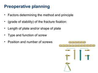 Preoperative planning
• Factors determining the method and principle
• (grade of stability) of the fracture fixation:
• Length of plate and/or shape of plate
• Type and function of screw
• Position and number of screws
 